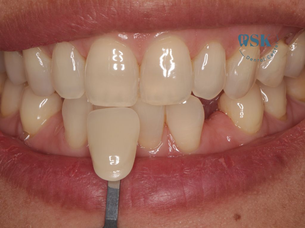 เทียบสีฟันก่อนฟอกสีฟันแบบไม่ใช้แสง ที่คลินิกทันตกรรมพีเอสเค PSK Dental Center รีวิวฟอกสีฟัน