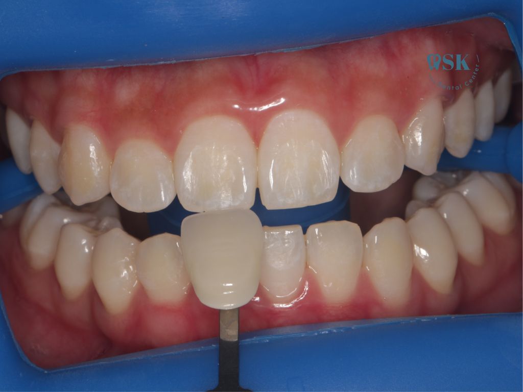 รีวิวฟอกสีฟันแบบไม่ใช้แสง รีวิวก่อนฟอกสีฟันแบบไม่ใช้แสงที่คลินิกทันตกรรมพีเอสเค