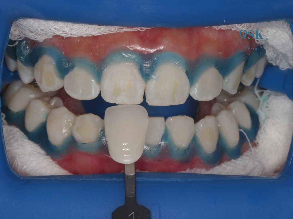 รีวิวฟอกสีฟันแบบไม่ใช้แสง รีวิวหลังฟอกสีฟันแบบไม่ใช้แสงที่คลินิกทันตกรรมพีเอสเค