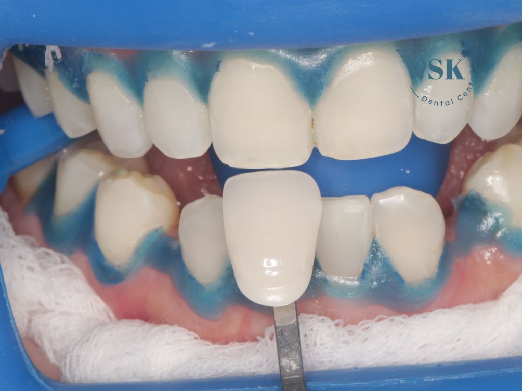 เทียบสีฟันหลังฟอกสีฟันแบบไม่ใช้แสง ที่คลินิกทันตกรรมพีเอสเค PSK Dental Center รีวิวฟอกสีฟัน