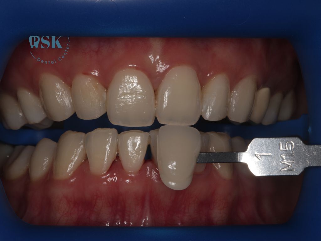 รีวิวฟอกสีฟันแบบใช้แสง ฟอกสีฟันใช้แสง cool light ด้วยระบบ zoom ของแท้ ที่คลินิกทันตกรรมพีเอสเค PSK Dental Center