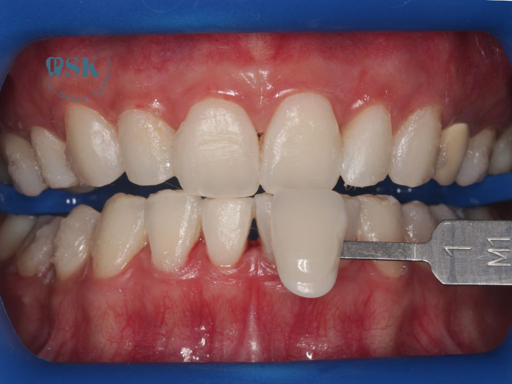 รีวิวฟอกสีฟันแบบใช้แสง ฟอกสีฟันใช้แสง cool light ด้วยระบบ zoom ของแท้ ที่คลินิกทันตกรรมพีเอสเค PSK Dental Center