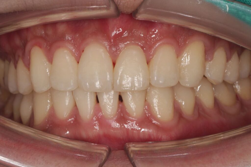 หลังจากจัดฟันเสร็จ ถอดเครื่องมือจัดฟัน ที่คลินิกทันตกรรมพีเอสเค จะได้ฟันที่เรียงสวยตามแบบของแต่ละท่าน